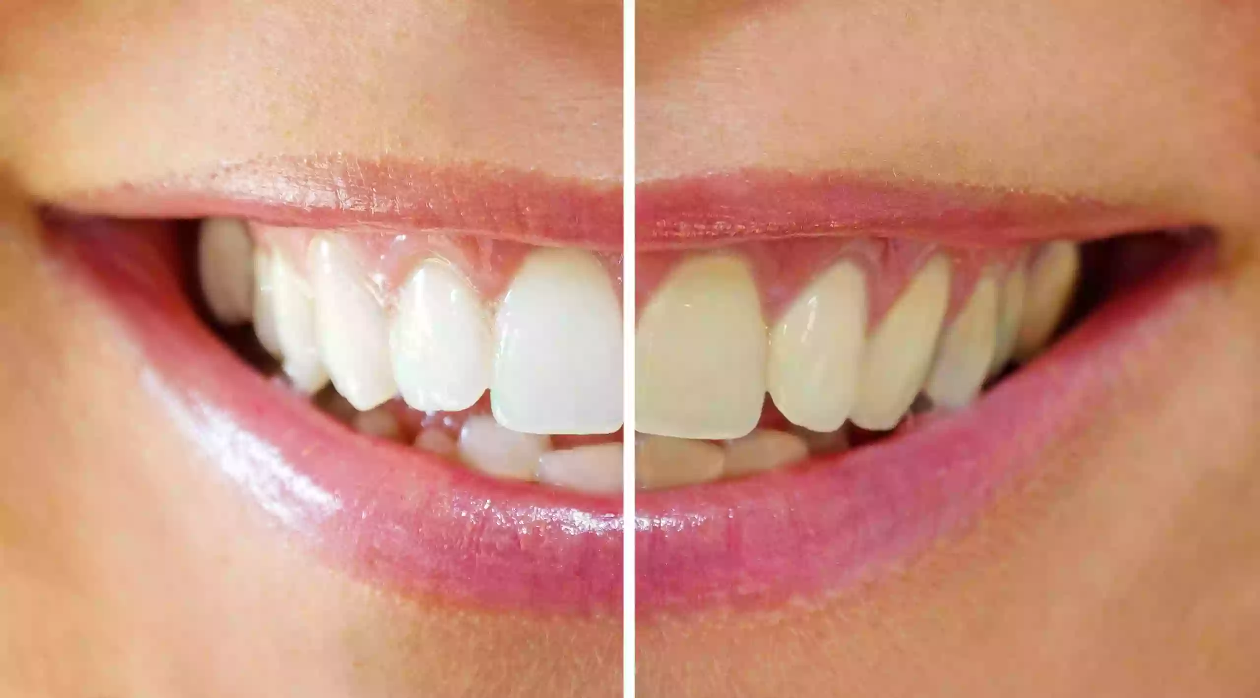 WHITEN UP TEETH WHITENING