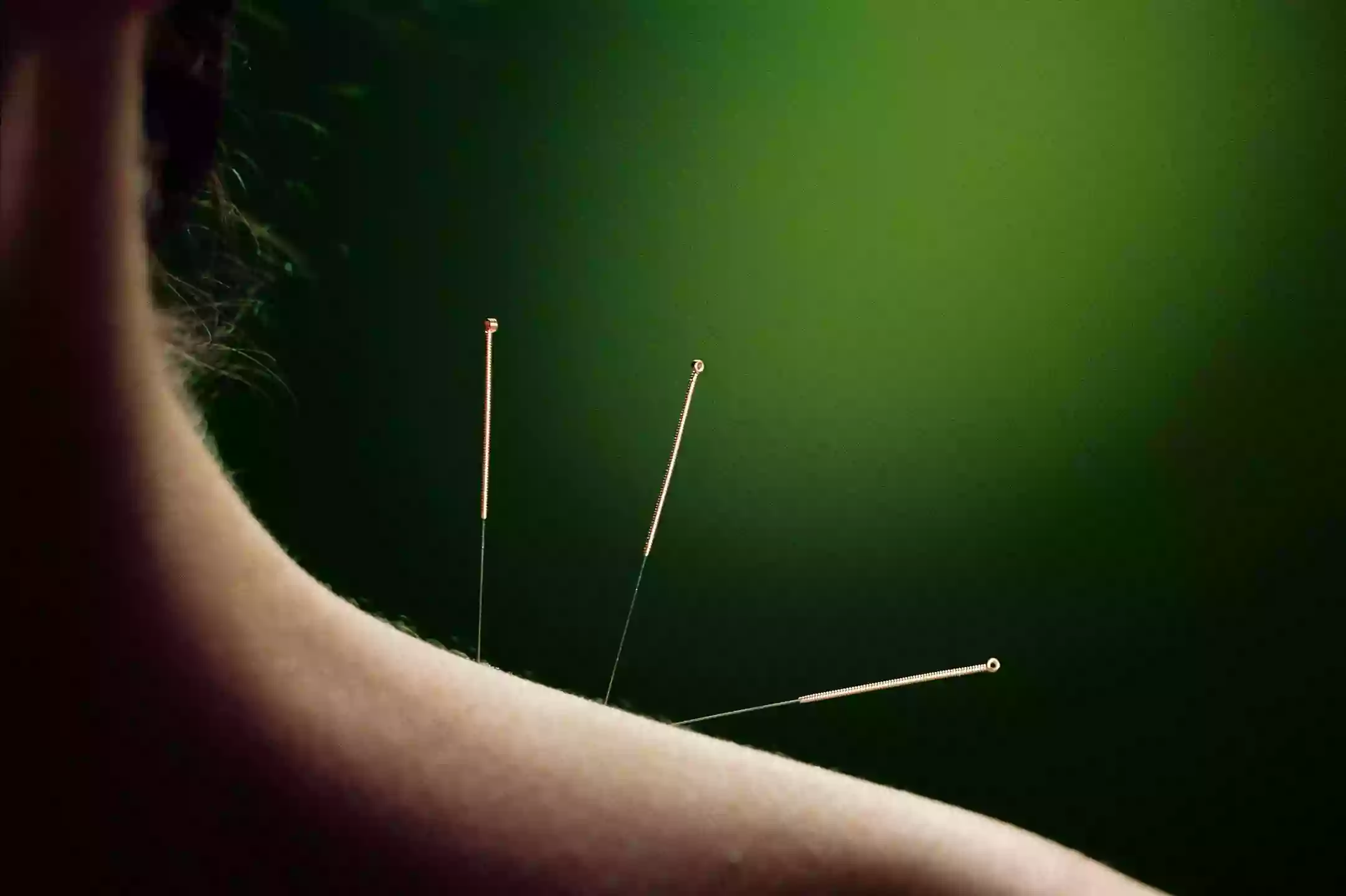 Master Acupuncture Hamilton