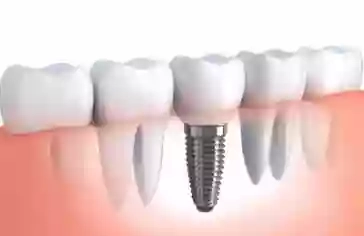 Implantatsiya zubov