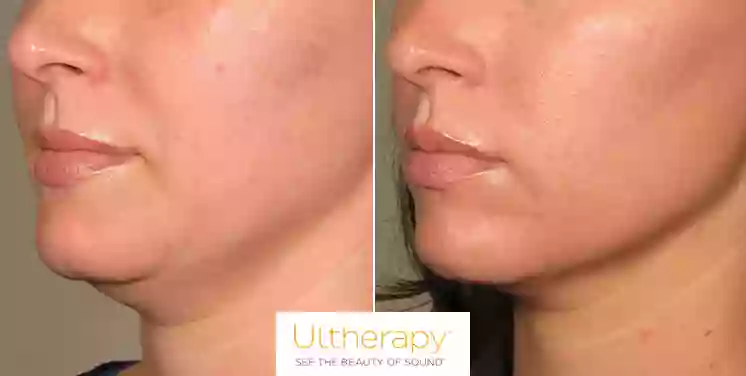 Ultherapy Center San Diego