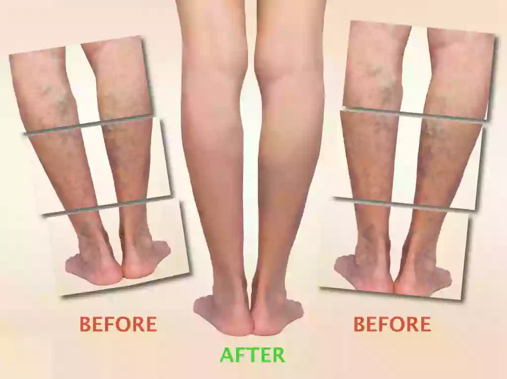 Varicose Vein Treatment San Diego