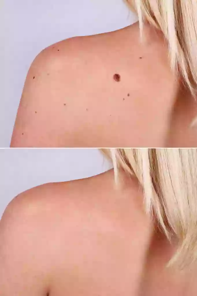 Mole Removal San Diego