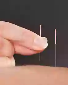 Get Your Qi On Acupuncture