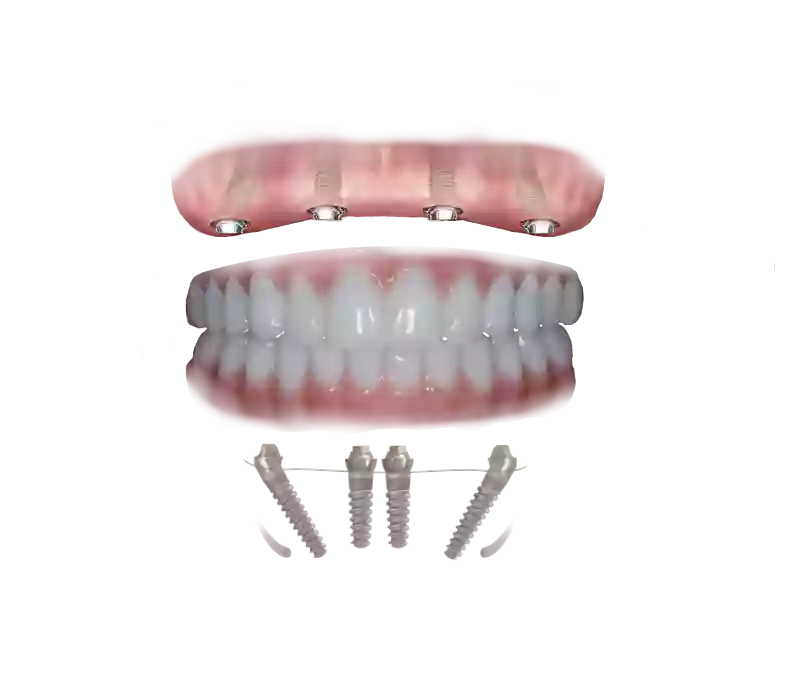 Digital dental implants