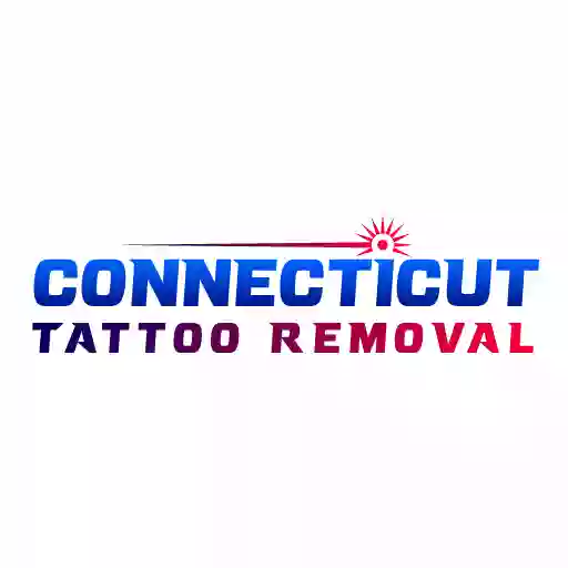 Connecticut Tattoo Removal