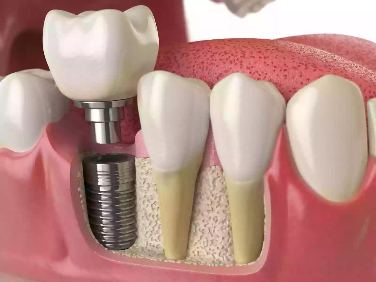 Dr. Evan Sachs Dental Implant Surgery