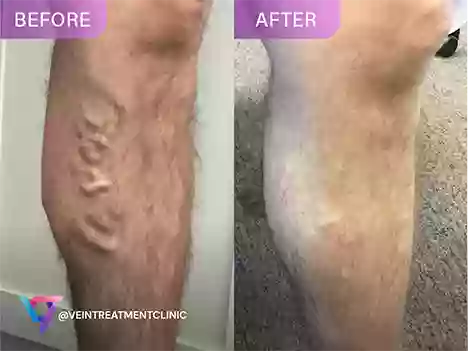 Vein Treatment Clinic