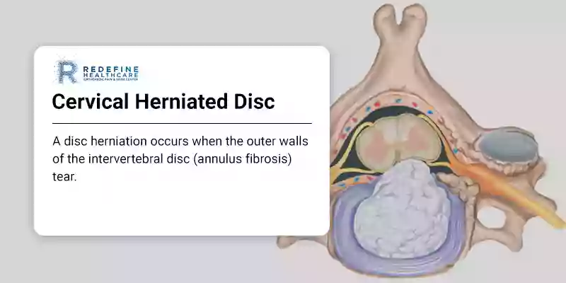 Herniated Disc In Neck And Back