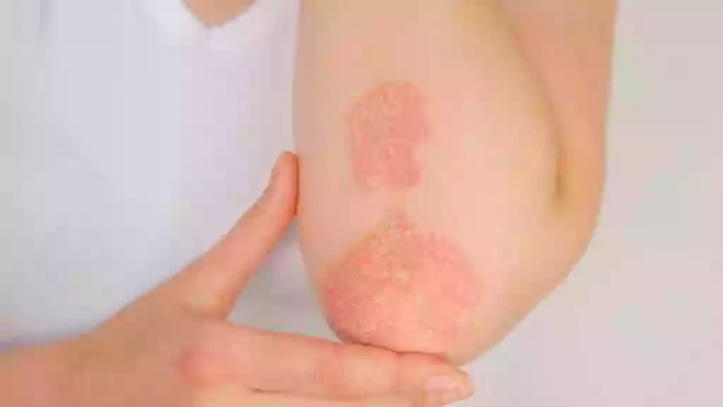 Psoriasis Treatment Center of Central New Jersey