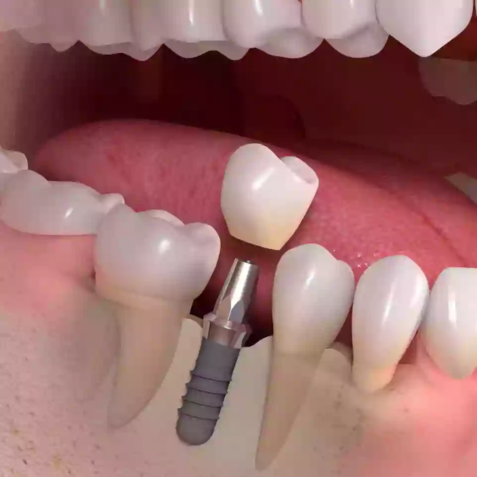 Implant Dental