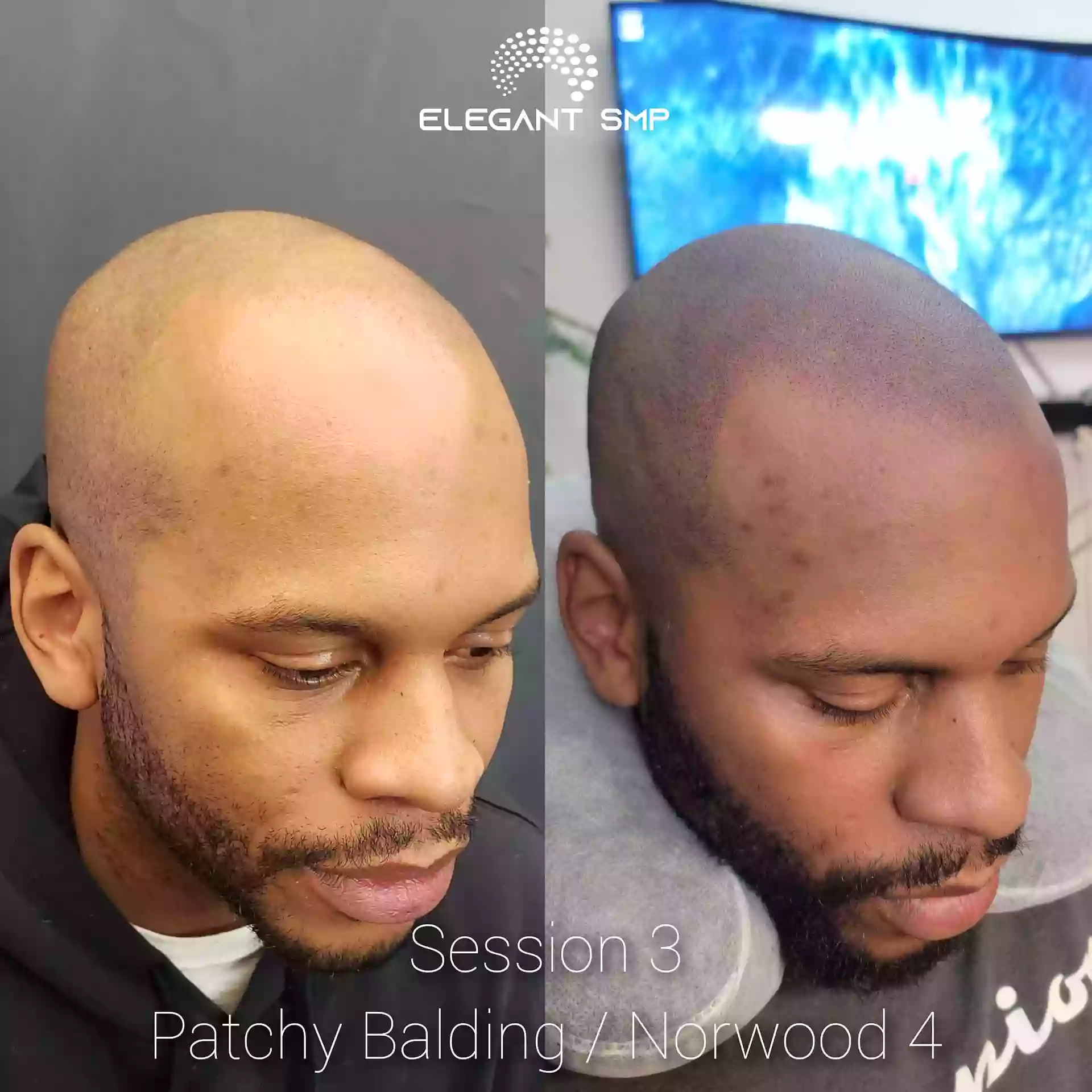 Elegant Scalp Micropigmentation