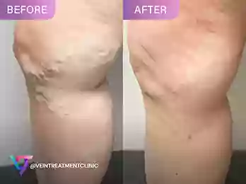 Vein Treatment Clinic