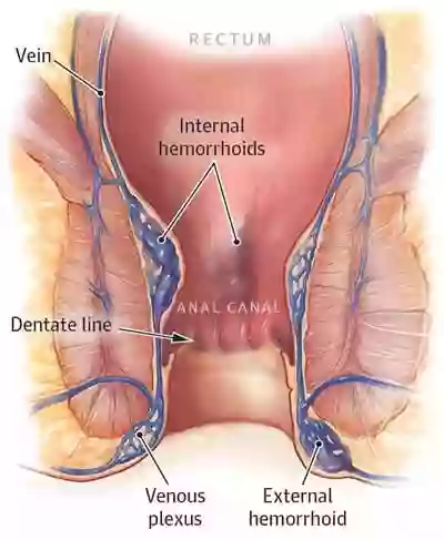 Hemorrhoid Treatment Doctors NYC