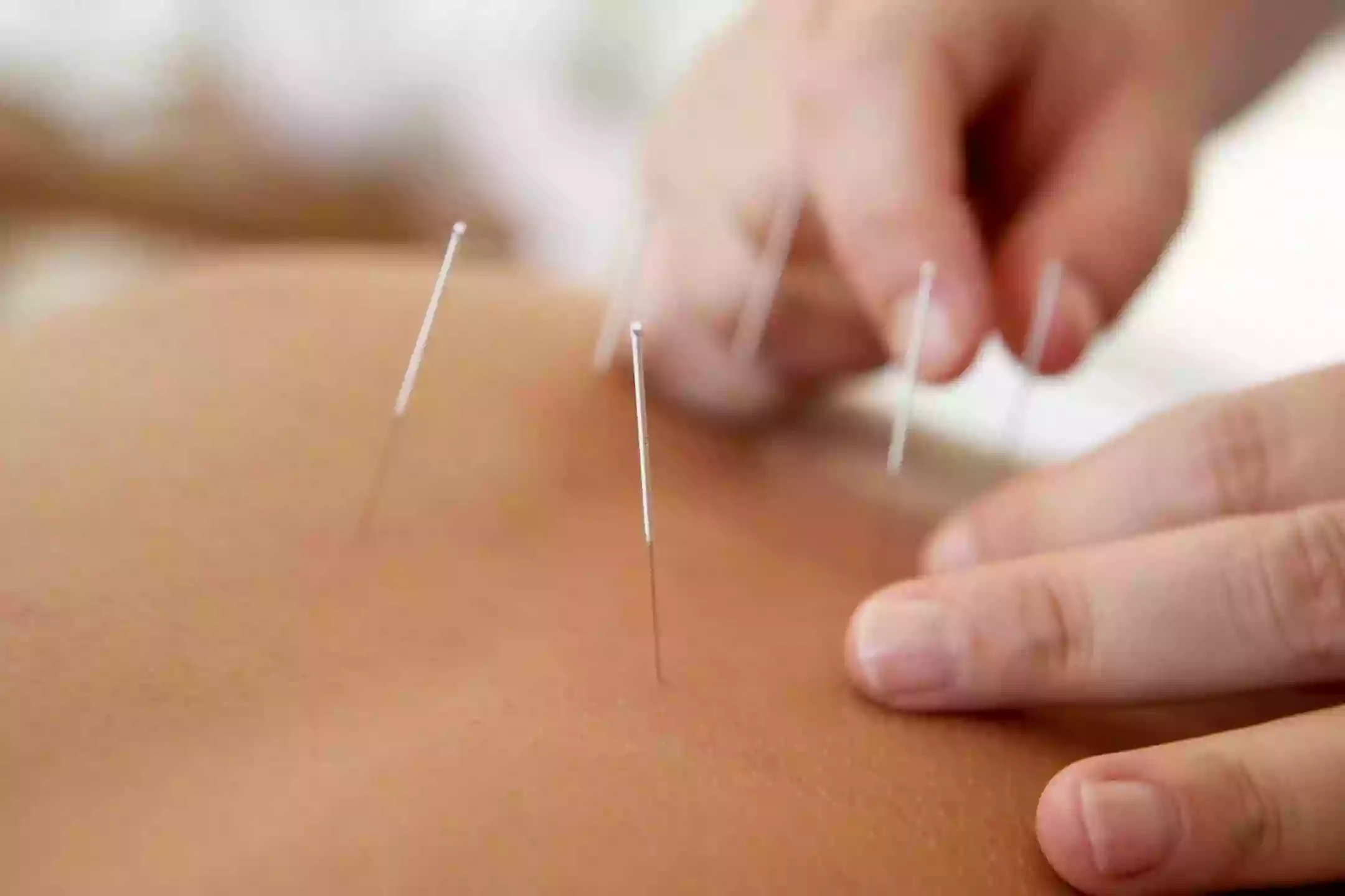 Pure Point Acupuncture