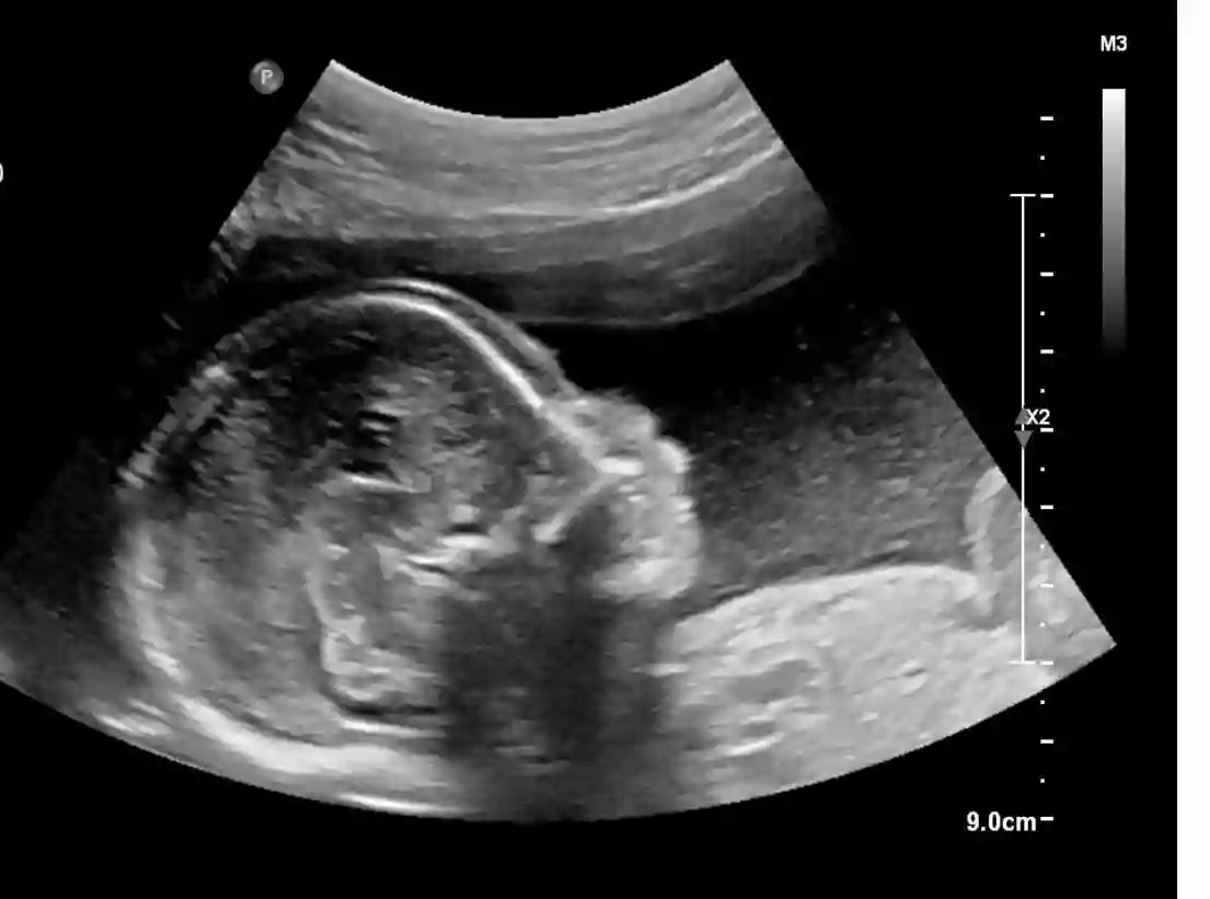 Sono Spotlight 3D Mobile Ultrasound