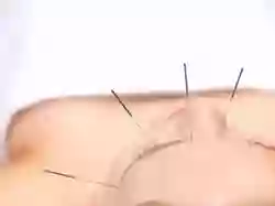 Naturally Acupuncture