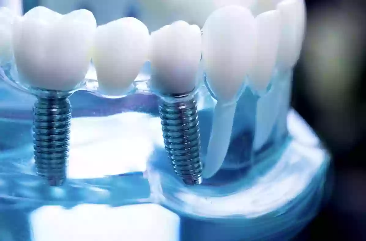 The Dental Implant Place