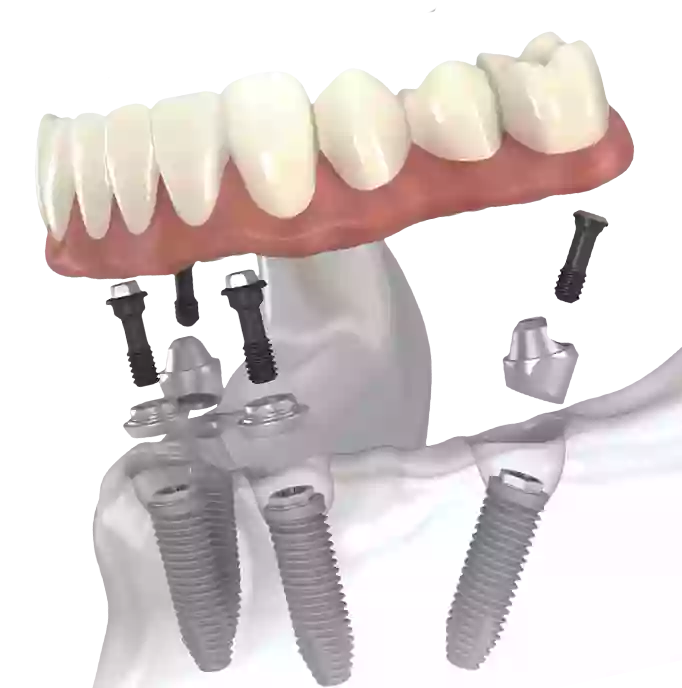 Union Dental Implant Center